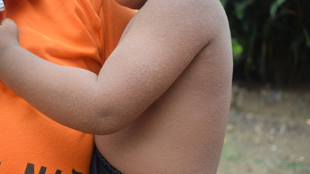 Como muchos otros menores de edad, una niña de cuatro años sufre una fuerte alergia sobre todo su cuerpo. Las mujeres responsabilizan a la calidad del agua de enfermar a la comunidad. Foto: Carlos Antonio Mayorga Alejo.